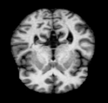 Alzheimer's Detection