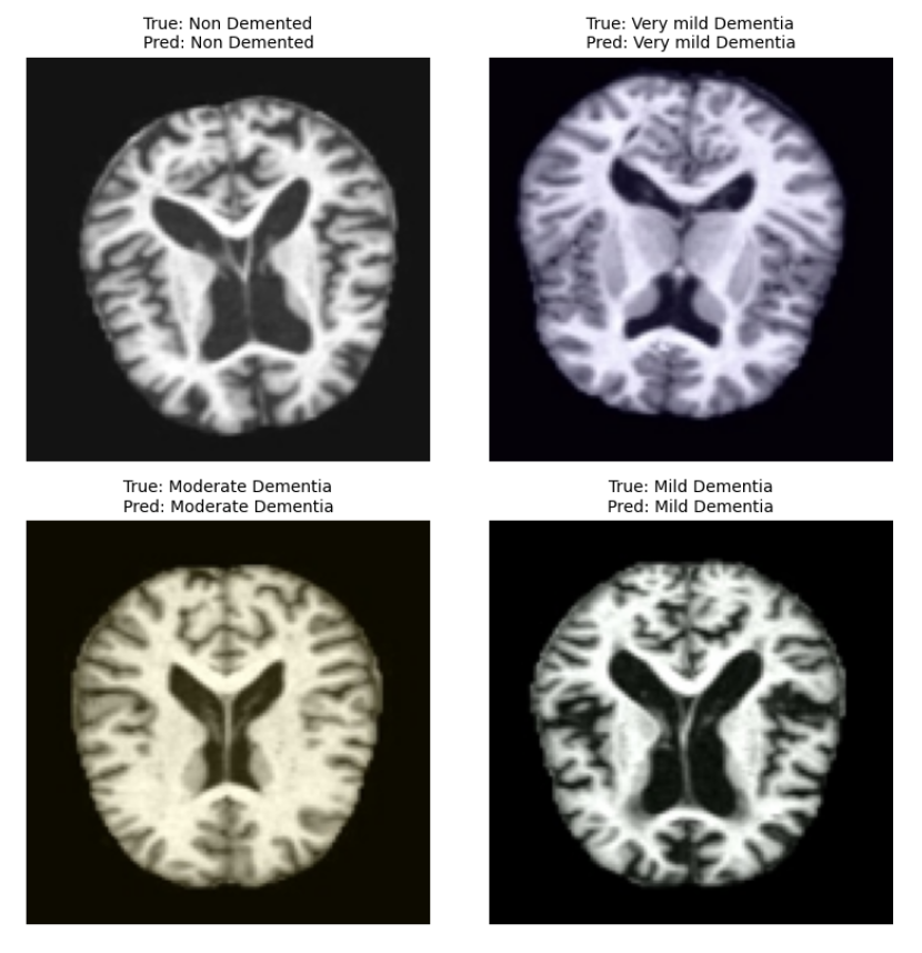 Alzheimer's Detection Exemple