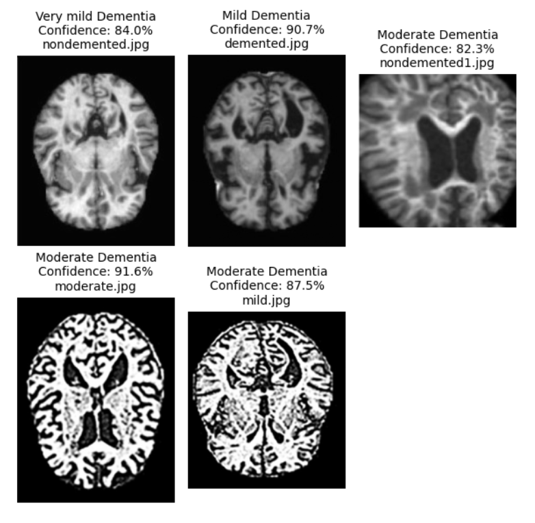 Alzheimer's Detection Exemple